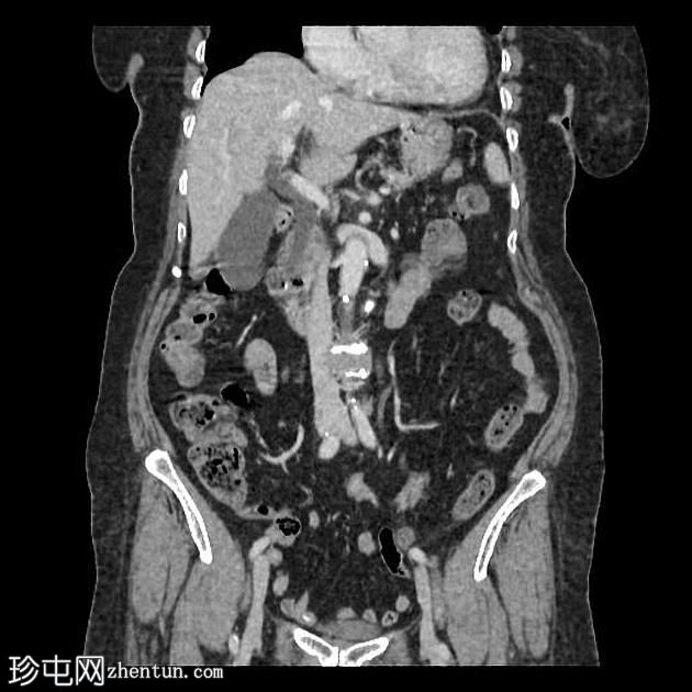 肠憩室梗阻性黄疸综合征（Lemmel Syndrome）