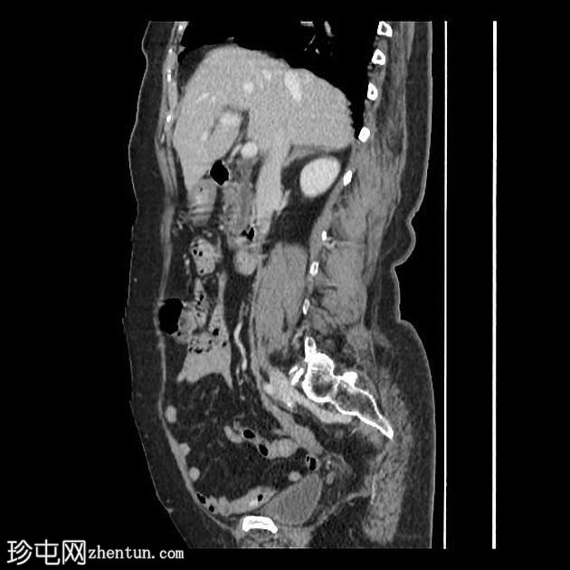 肠憩室梗阻性黄疸综合征（Lemmel Syndrome）