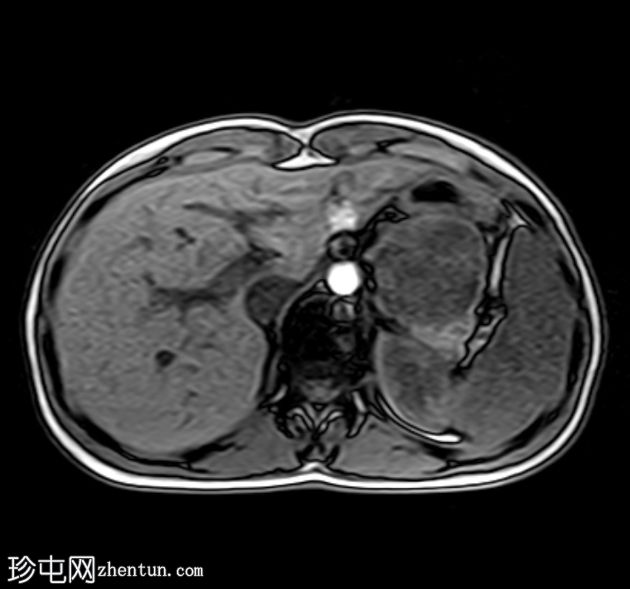 胰腺实体性假乳头状瘤(Frantz瘤)