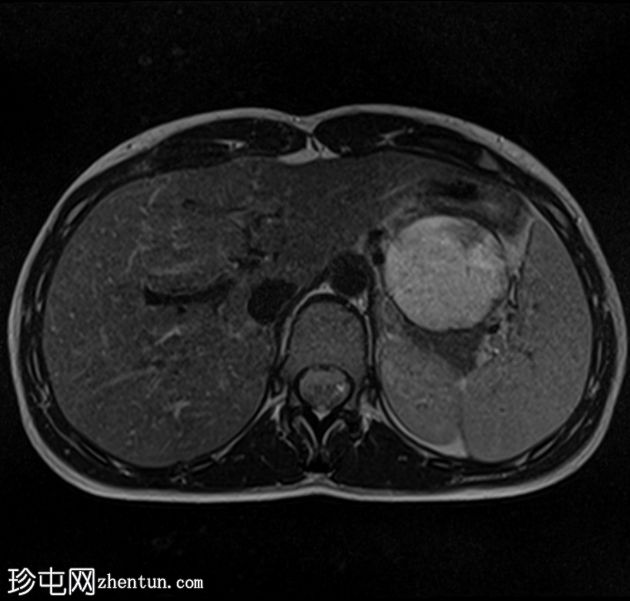 胰腺实体性假乳头状瘤(Frantz瘤)