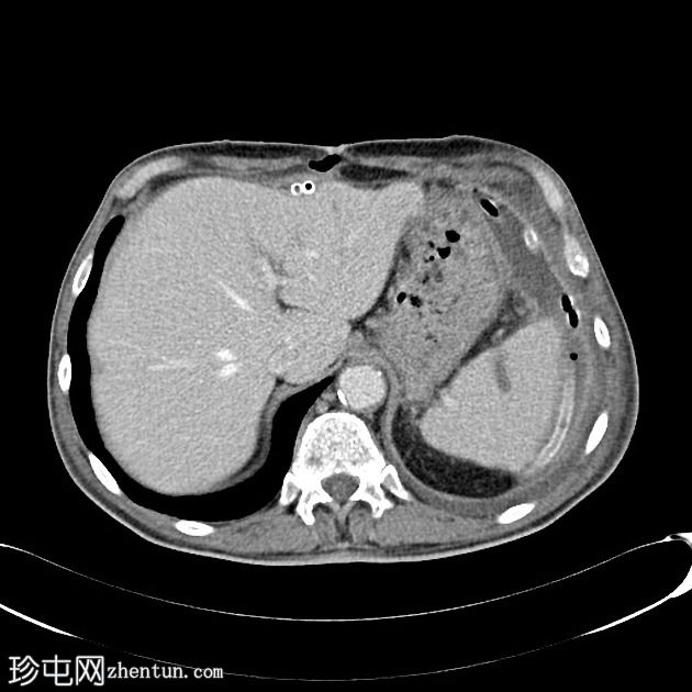 慢性胰腺炎合并肝内和脾内假性囊肿