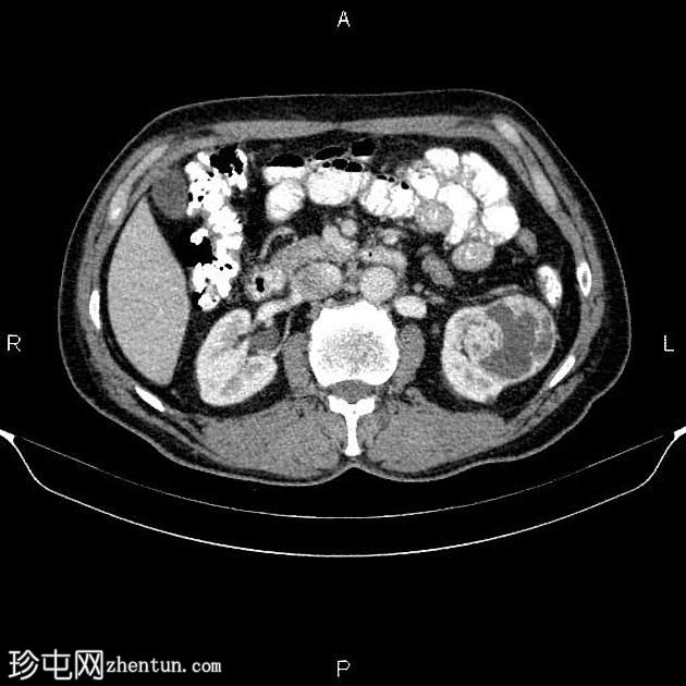 肾复合体囊肿（Bosniak IV 类）