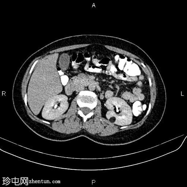 肾血管平滑肌脂肪瘤(Renal angiomyolipoma,RAML)