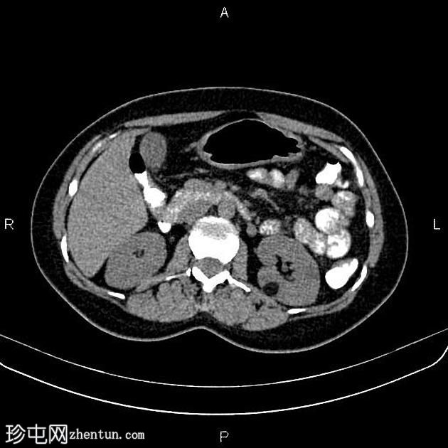 肾血管平滑肌脂肪瘤(Renal angiomyolipoma,RAML)