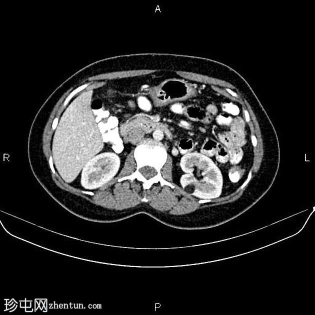 肾血管平滑肌脂肪瘤(Renal angiomyolipoma,RAML)