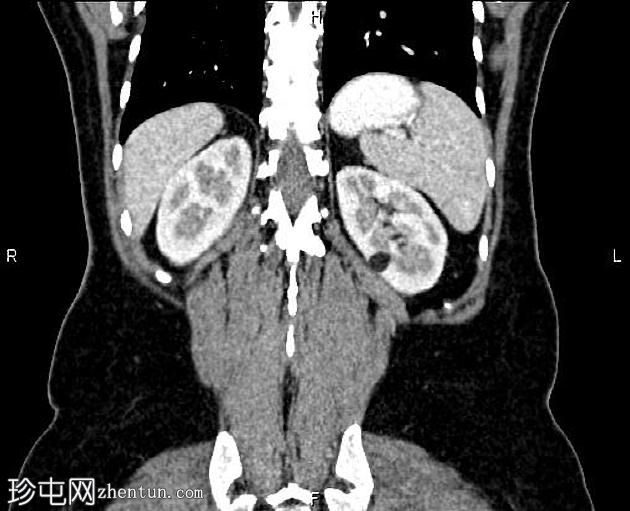 肾血管平滑肌脂肪瘤(Renal angiomyolipoma,RAML)