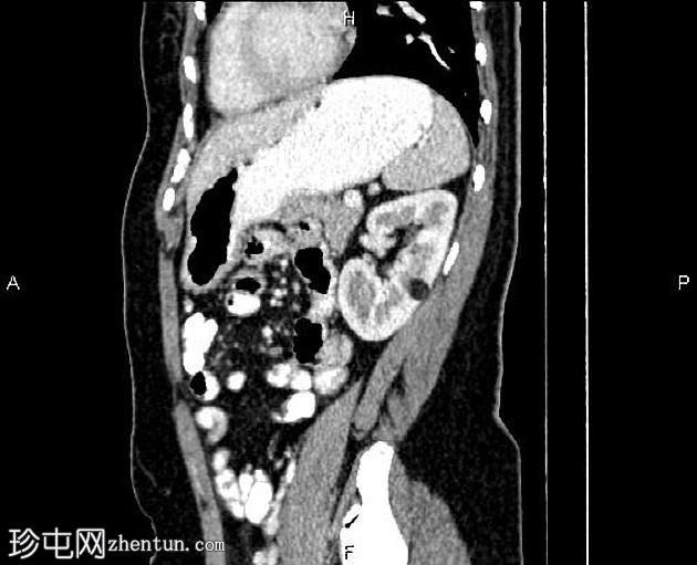 肾血管平滑肌脂肪瘤(Renal angiomyolipoma,RAML)