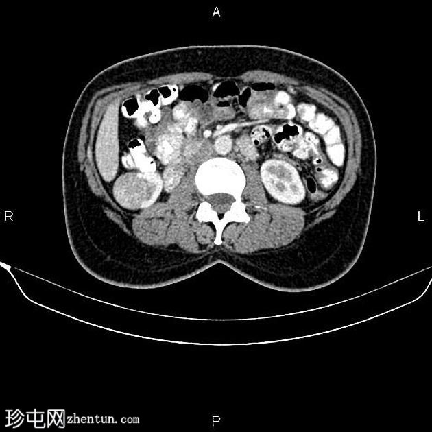 肾细胞癌(renal cell carcinoma ) 