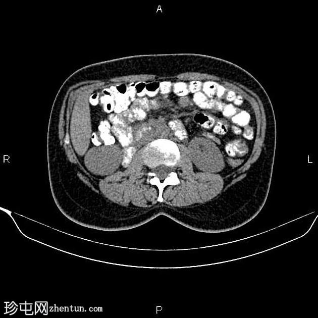 肾细胞癌(renal cell carcinoma ) 