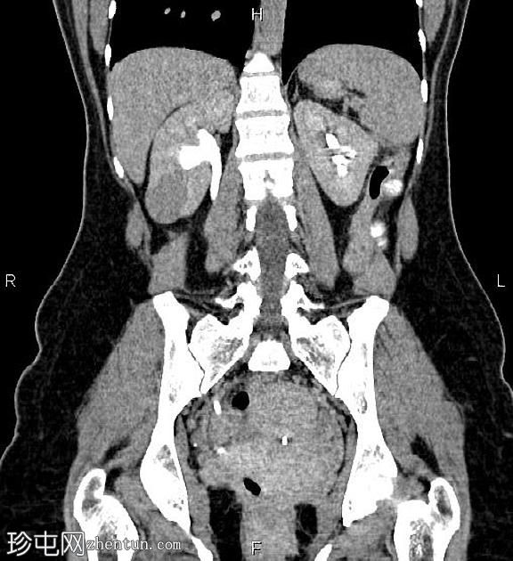 肾细胞癌(renal cell carcinoma ) 