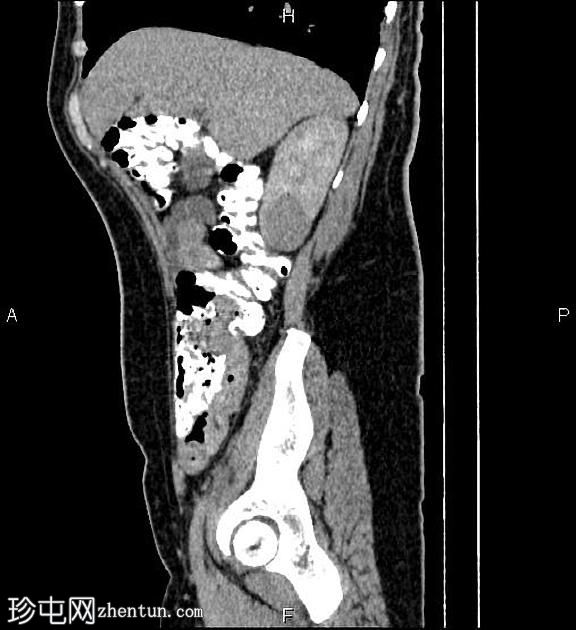 肾细胞癌(renal cell carcinoma ) 