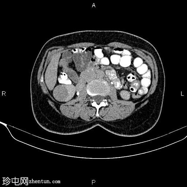 肾细胞癌(renal cell carcinoma ) 