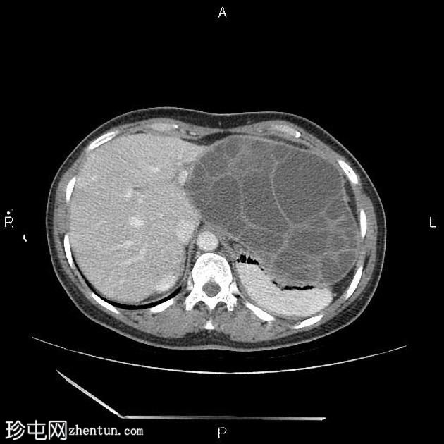 腹膜包虫病