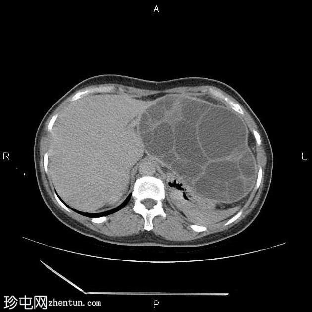 腹膜包虫病