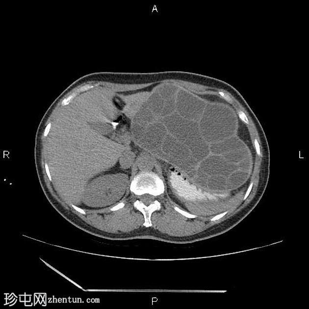 腹膜包虫病