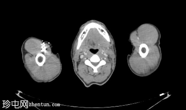 舌癌 (PET-CT)