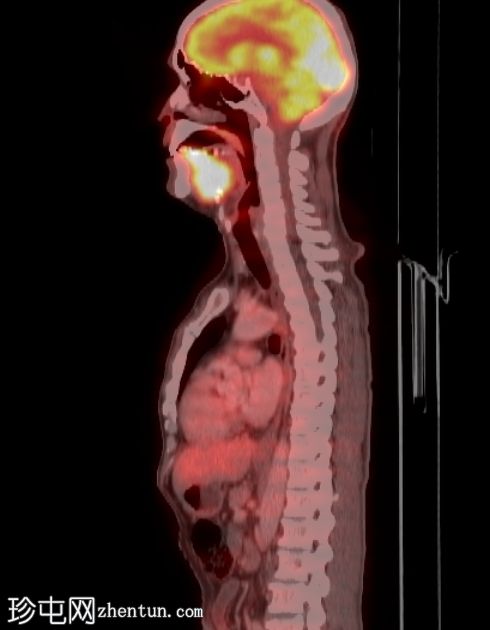 舌癌 (PET-CT)