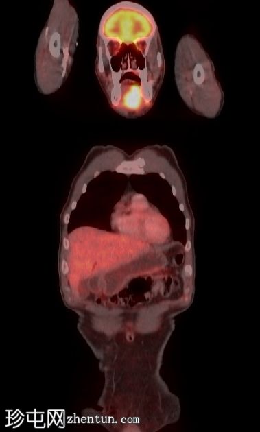 舌癌 (PET-CT)