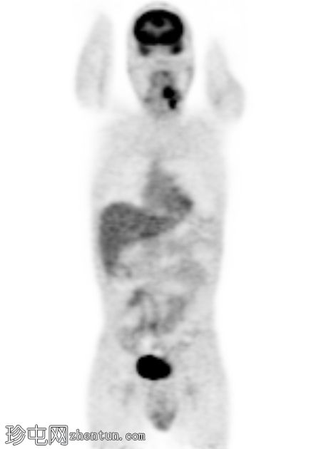 舌癌 (PET-CT)