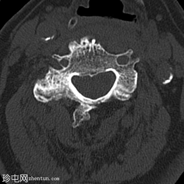复杂颈椎骨折