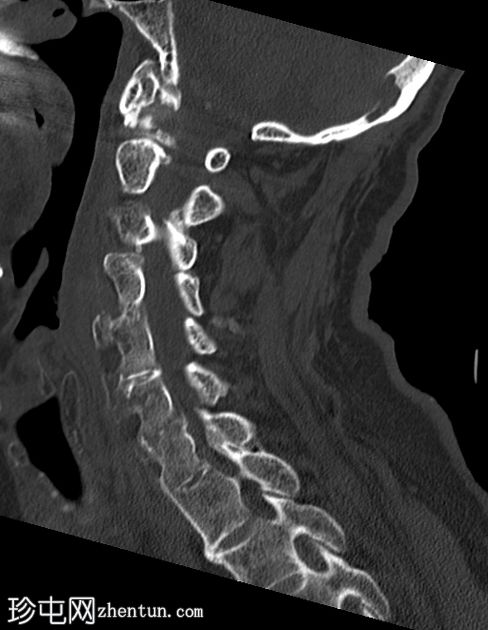 复杂颈椎骨折