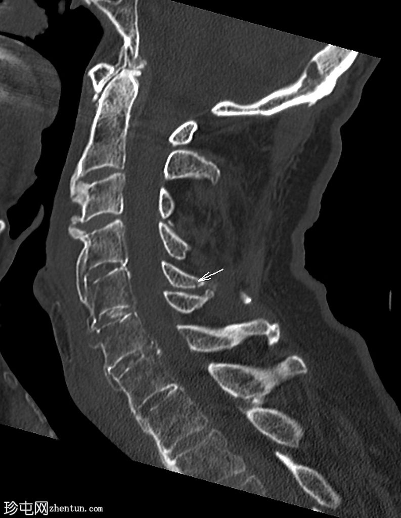 复杂颈椎骨折