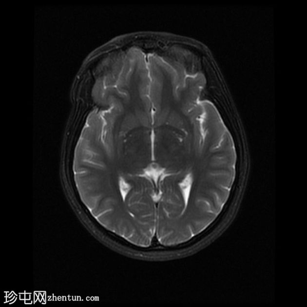 颅内表皮样囊肿