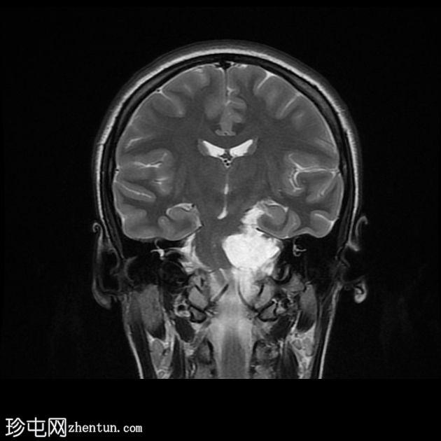 颅内表皮样囊肿