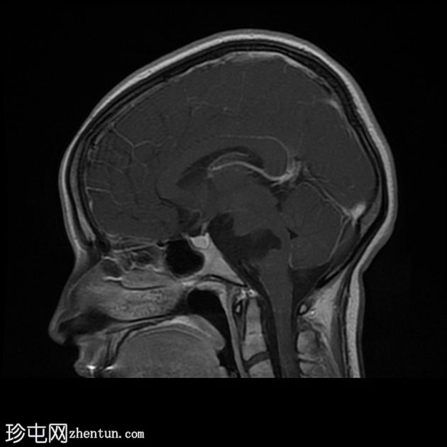 颅内表皮样囊肿