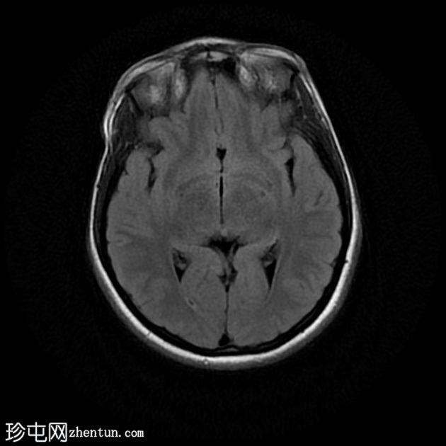 颅内表皮样囊肿