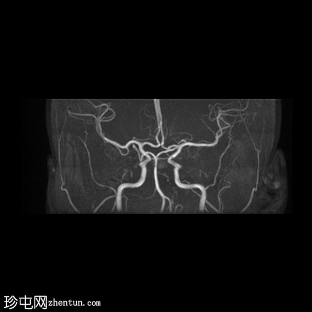 颅内表皮样囊肿