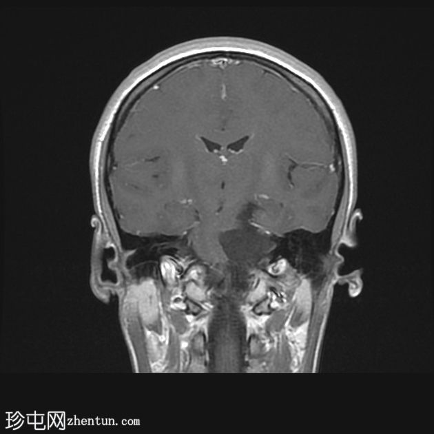 颅内表皮样囊肿