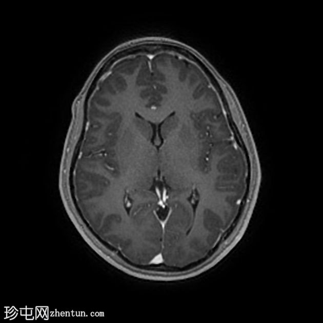 颅内表皮样囊肿