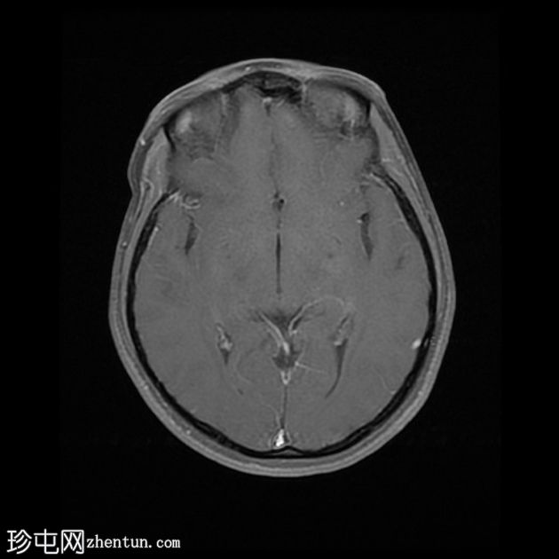 颅内表皮样囊肿