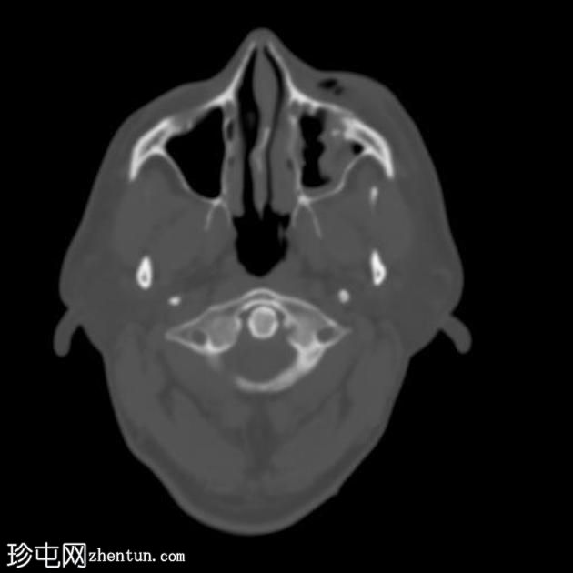 复杂的面部骨折