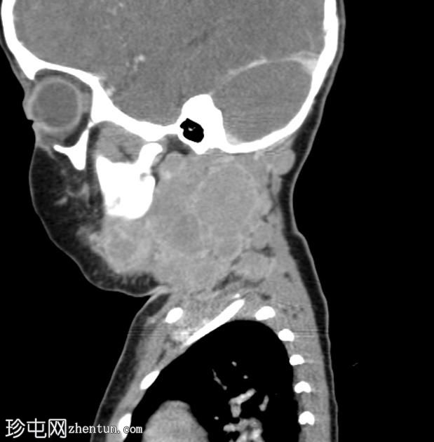 朗格汉斯细胞组织细胞增生症 (LCH)