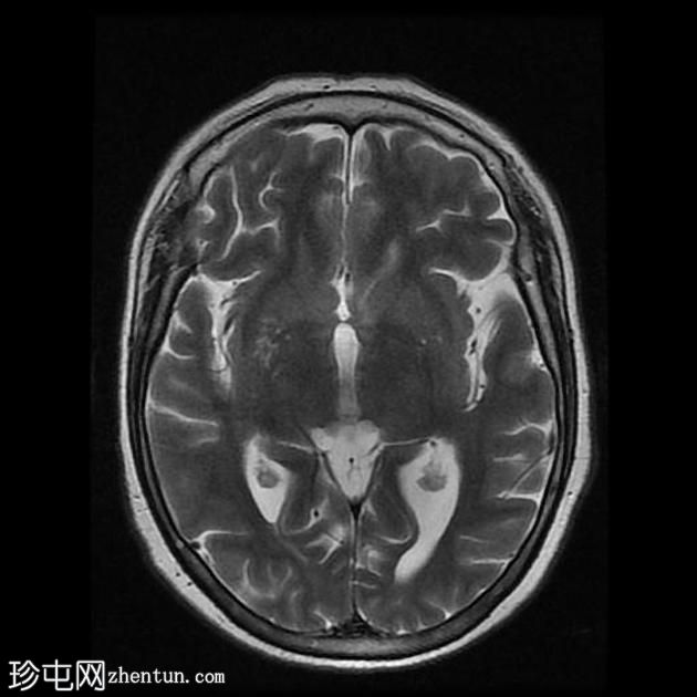 外眦鳞状细胞癌 - 复发