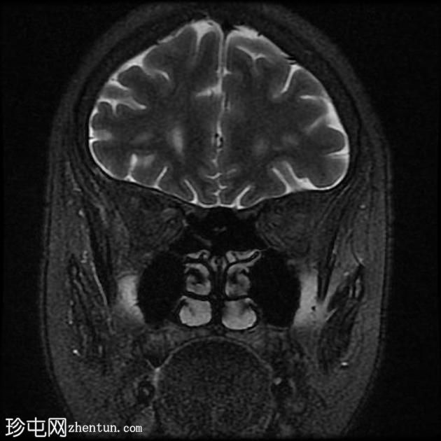 外眦鳞状细胞癌 - 复发