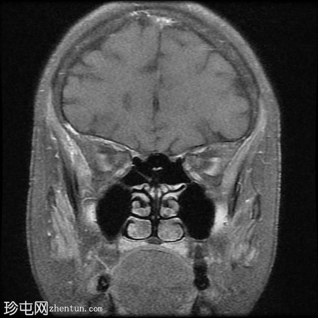 外眦鳞状细胞癌 - 复发