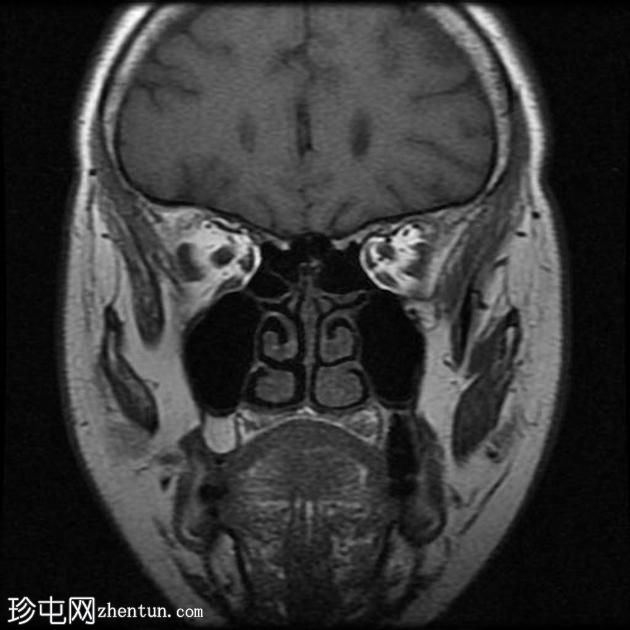 外眦鳞状细胞癌 - 复发