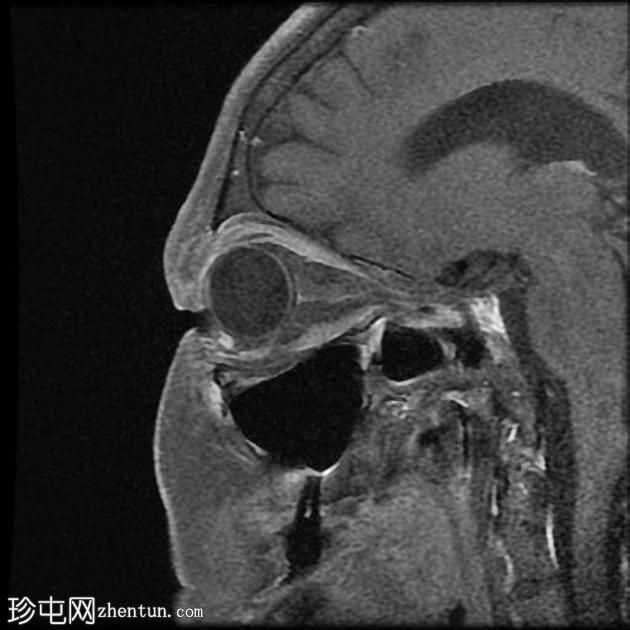 外眦鳞状细胞癌 - 复发