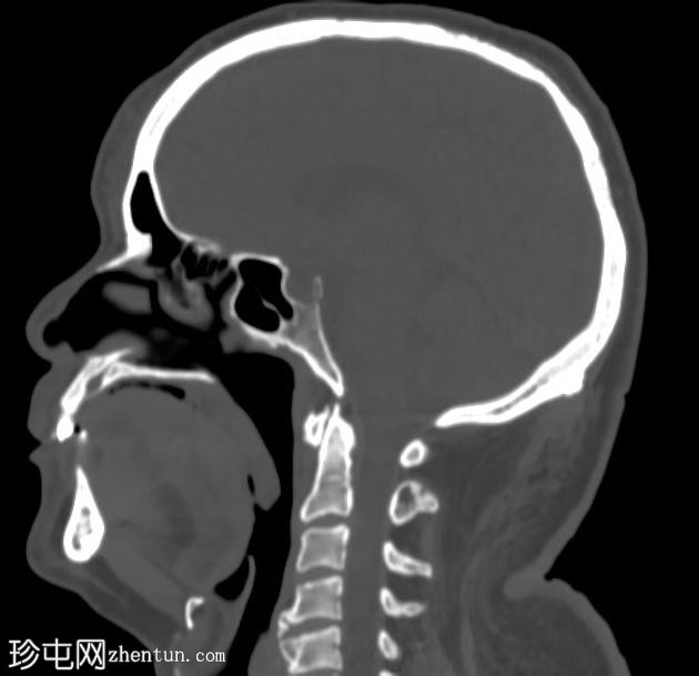 青光眼引流装置