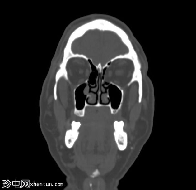 青光眼引流装置