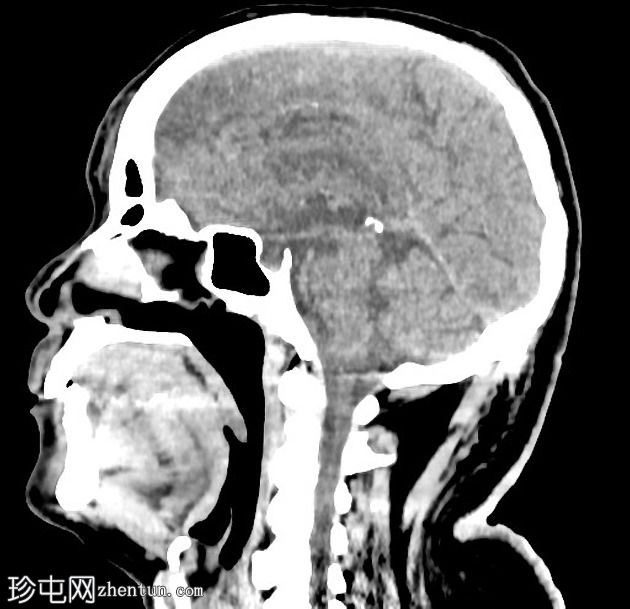 青光眼引流装置