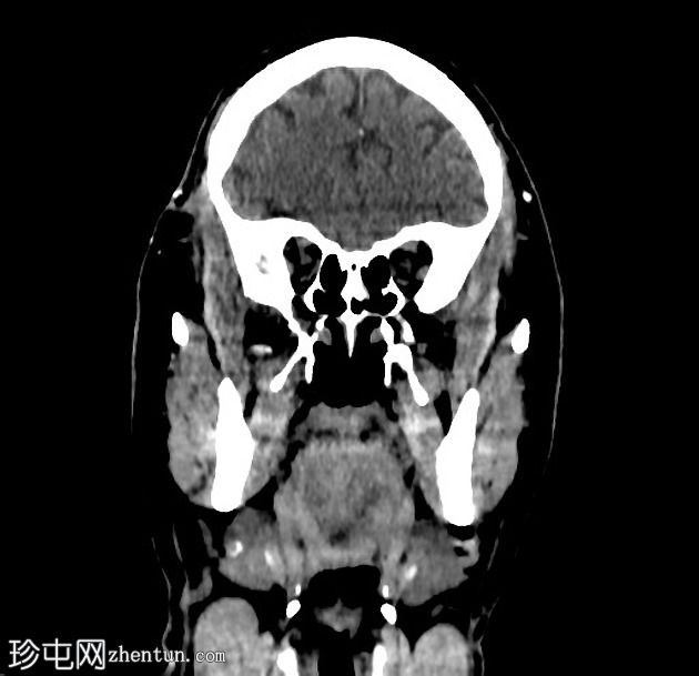 青光眼引流装置