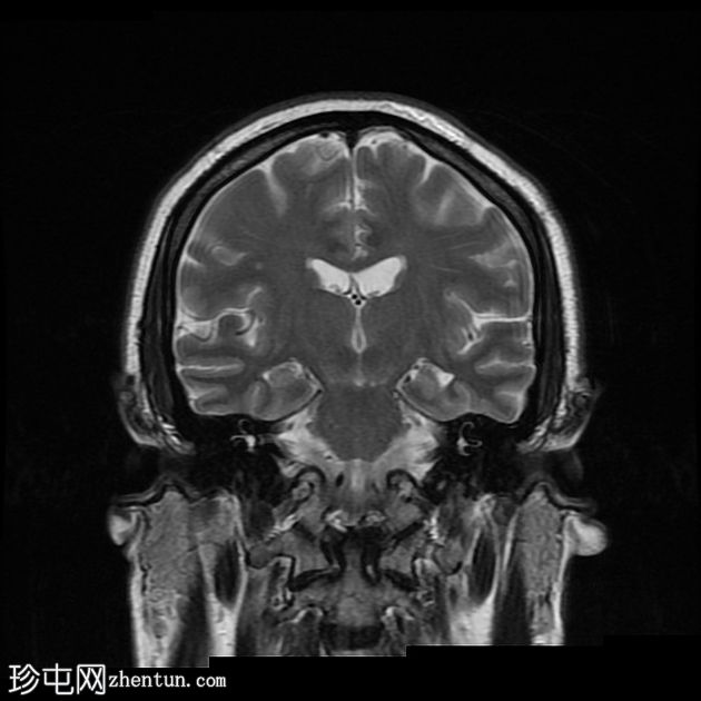 青光眼引流装置