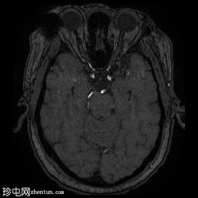 青光眼引流装置