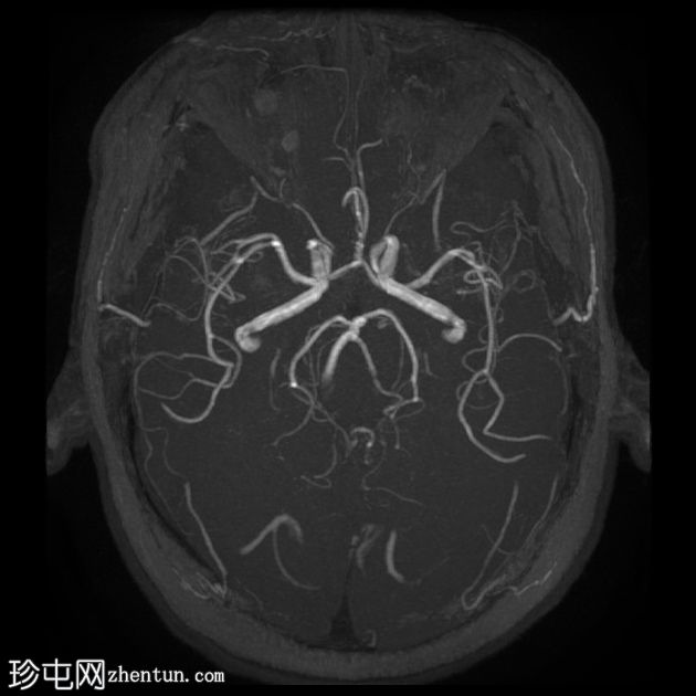 青光眼引流装置