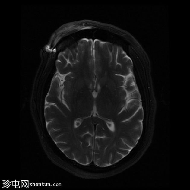 青光眼引流装置