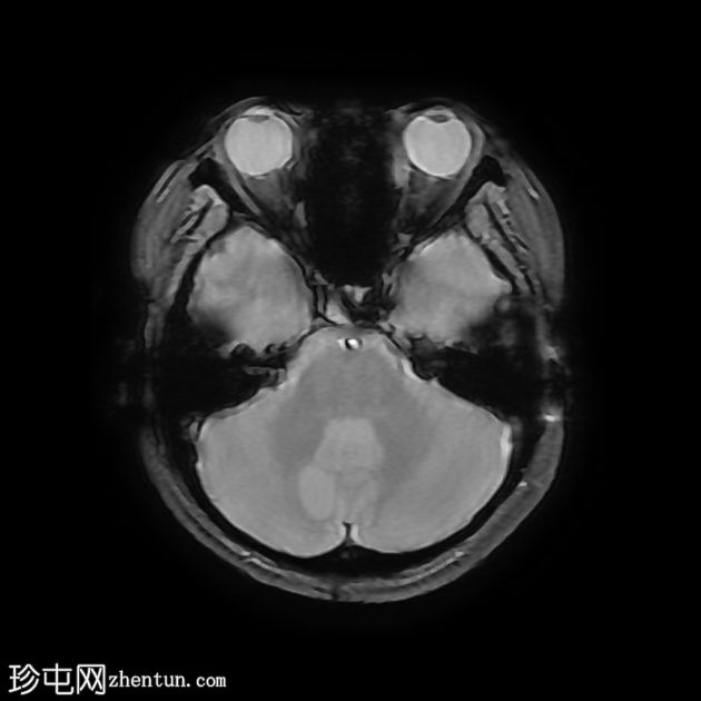 Von Hippel-Lindau 综合征